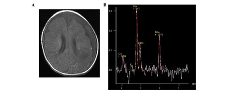 Early Identification Of Hypoxic‑ischemic Encephalopathy By Combination