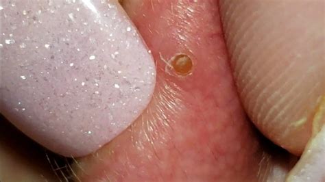 CRAZY Popping Huge Blackheads And Pimple Popping BEST Pimple Popping