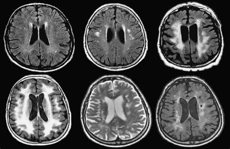 Mri In Dementia Radiology Key