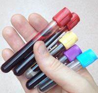 Причины повышения АЛТ в анализе крови Картинка - Причины повышения АЛТ в анализе крови