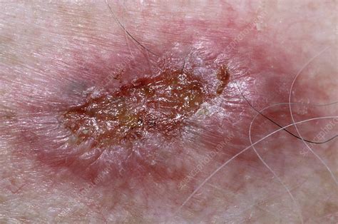 Ulcerated Basal Cell Carcinoma Stock Image C0031282 Science