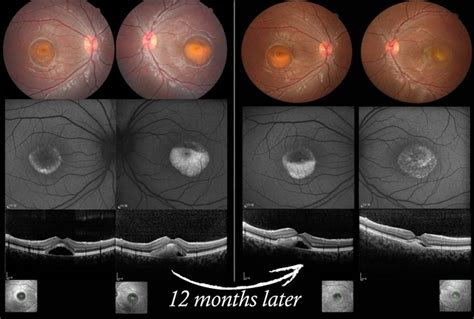 Vitelliform Macular Dystrophy Or Best Disease Retina Image Bank