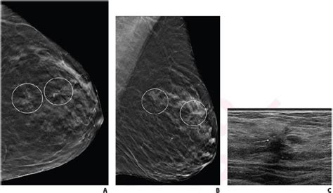 Single Vs Multiple Architectural Distortion On Digital Breast