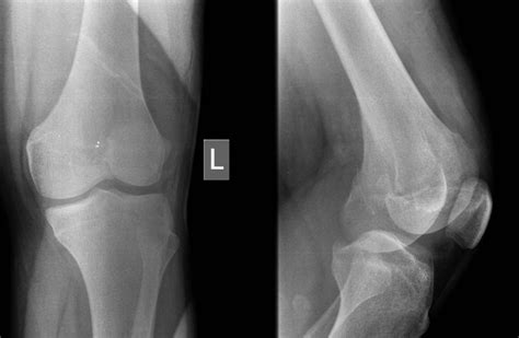 Arthroscopic Management Of A Posterior Femoral Condyle Hoffa Fracture Surgical Technique