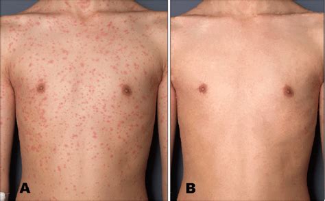 Clinical Features Of Pityriasis Rosea Before A And After B Uva1