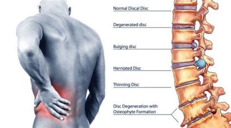 Herniated Disc Chiropractor Slipped Disc Pinched Nerve
