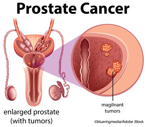Prostate Cancer Multigene Biomarker Validated As Prognostic Predictive Test Physician S Weekly