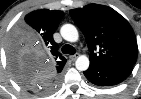 Multidetector Ct For Evaluation Of The Extrapleural Space Radiographics