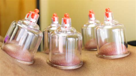 Cupping Therapy One On One Physical Therapy Atlanta