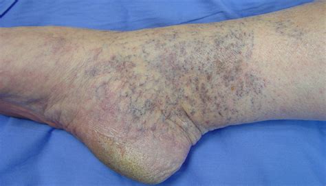 Venous Disorders Ankle Spider Veins