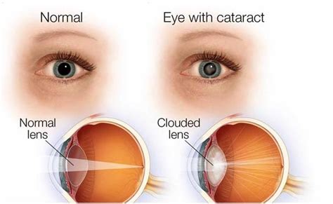 which is the best intraocular lens iol for cataract surgery axis eye clinic
