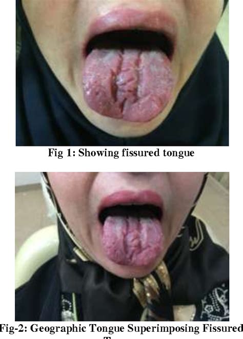 Figure 1 From Treatment Of Geographic Tongue Superimposing Fissured