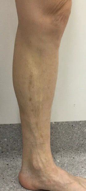 Varicose Vein Results And Post Treatment Photos — The Leg Vein Doctor