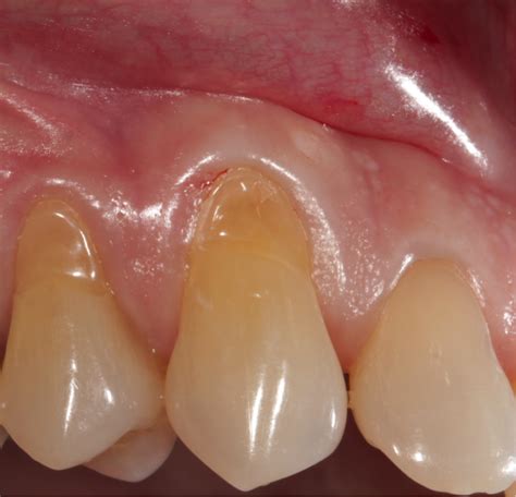 Gingival Recession Which Surgical Treatment Technique National Elf