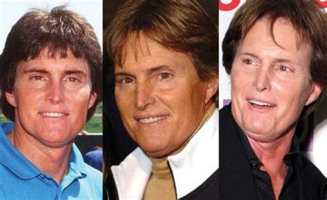 Bruce Jenner Plastic Surgery Before And After Pictures 2022