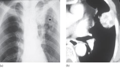 3 Chest Radiograph And High Resolution Ct Hrct Of A Patient With