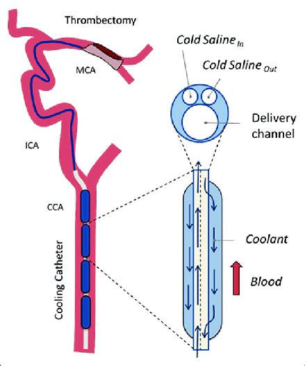 Schematic Depiction Of The Cooling Catheter Construction And Flow