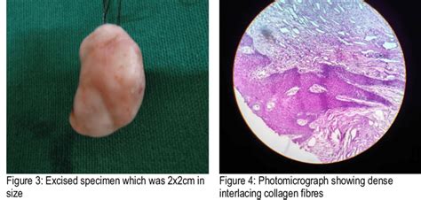 Fibroma In The Right Pterygomandibular Raphe Figure 2 After Excision