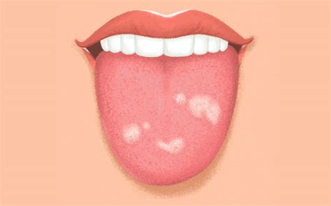 White Spots On Tongue White Spots On Tongue Bumps Patches Painful