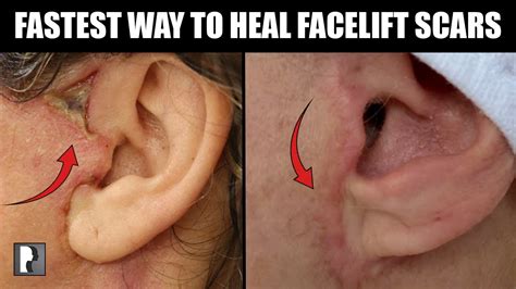 Fastest Way To Heal Facelift Scars After Surgery Facial Cosmetic