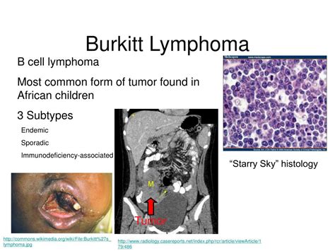 Ppt Burkitt Lymphoma And Myelocytomatosis Proto Oncogene Myc