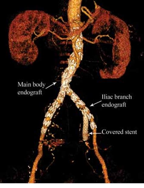 Figure 2 From Endovascular Treatment Of Isolated Bilateral Internal