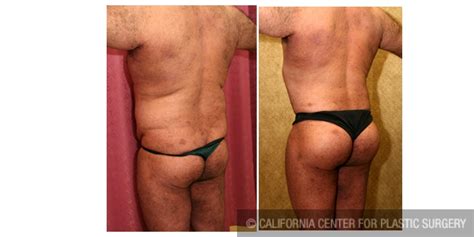 Patient Buttock Lift Augmentation Before And After Photos Beverly Hills Plastic Surgery