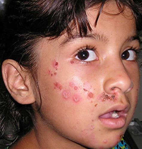 Fast Impetigo Cure Review Read This First