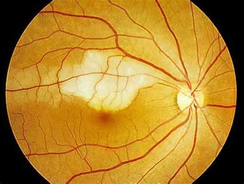 Retinal Artery Occlusion Causes Symptoms Diagnosis Treatment And Prognosis