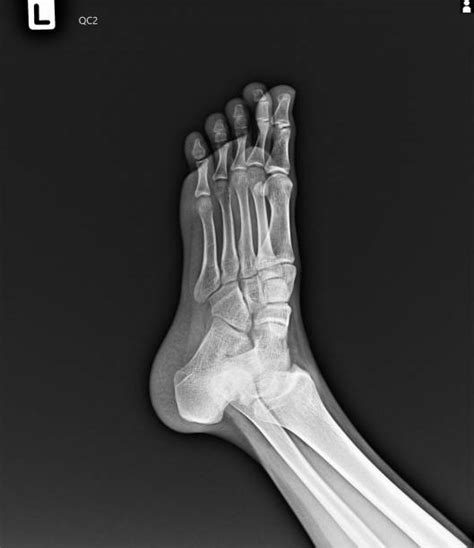 60 Normal Foot X Ray Pics Stock Photos Pictures And Royalty Free Images