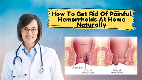 How To Get Rid Of Painful Hemorrhoids At Home Naturally Youtube