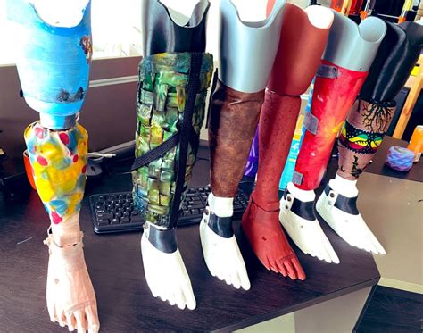 3d Printed Designed Prosthetics Afoot In The Gambia United Nations
