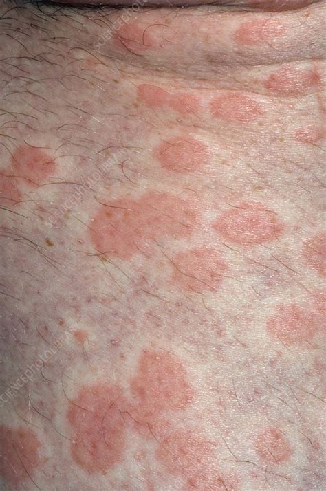 Urticaria Rash On The Skin Stock Image C0029568 Science Photo