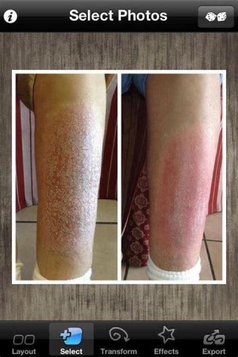 This Is Amazing Psoriasis Before And After Why Wouldnt You Give This