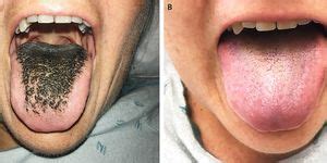 Larvae breathe through spiracles located on their eighth abdominal segments, or through a siphon, so must come to the surface frequently. Woman Finds a Human Botfly Larva Burrowed Into Skin