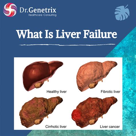 What Is Liver Failure Drgenetrix