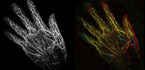 Imaging Blood Vessels At The Speed Of Sound