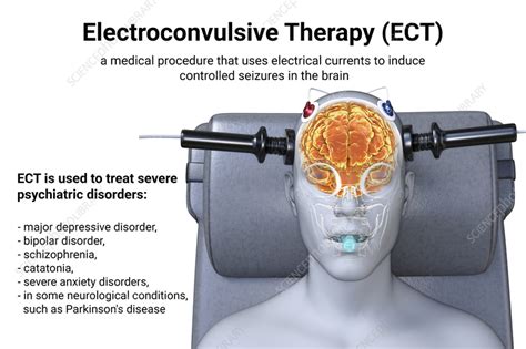 electroconvulsive therapy illustration stock image f037 6789 science photo library