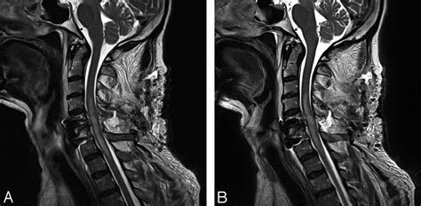 Blade In Sagittal T2 Weighted Mr Imaging Of The Cervical Spine