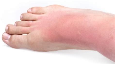 9 Tips To Treat Sunburn Swelling Ankles That Actually Work ⬅️