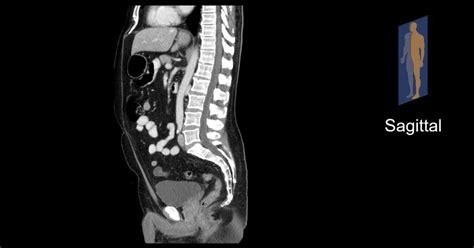 Sagittal Ct