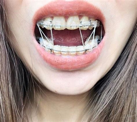 Clear Braces With Black Bands Braces Post