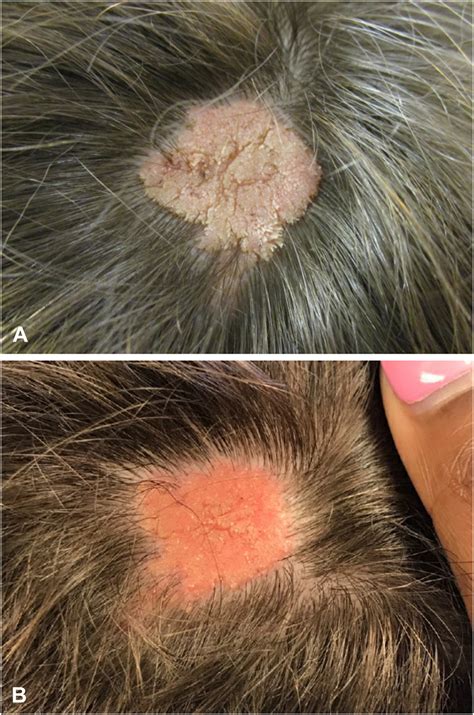 Topical Sirolimus Therapy For Nevus Sebaceus And Epidermal Nevus A