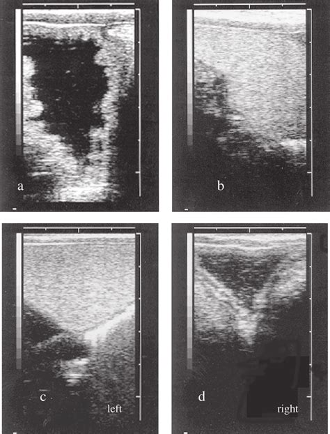 Examples Of Ultrasound Images Of Vesicular Glands A Most