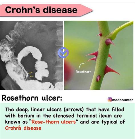 Rosethorn Ulcer Of Crohns Disease Medizzy