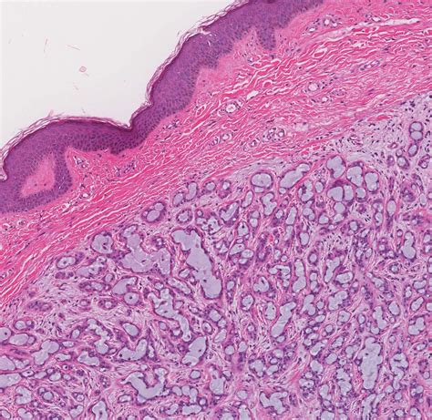 Pathology Outlines Chondroid Syringoma
