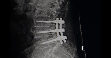 Nashville Tn Lumbar Interbody Fusion Dube Orthopedics
