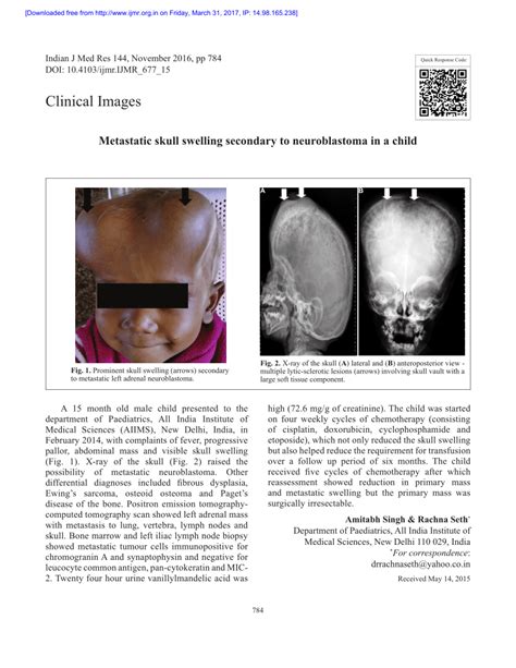 Pdf Metastatic Skull Swelling Secondary To Neuroblastoma In A Child