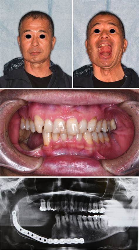Patient 2 48 Months Post Surgery A Extraoral Postoperative