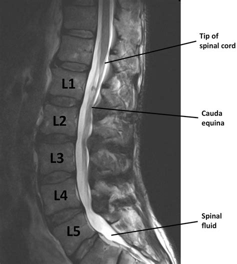 Imaging The Back And Sciatic Nerve Springerlink